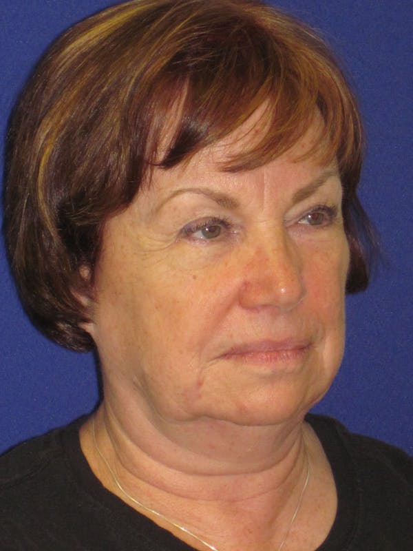 Facelift/Mini-Facelift Before & After Gallery - Patient 4890537 - Image 5