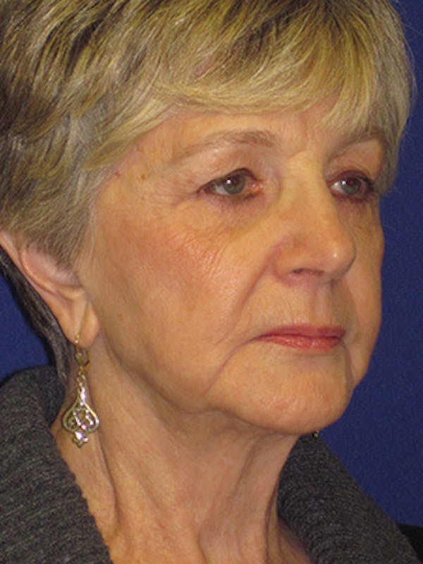 Facelift/Mini-Facelift Before & After Gallery - Patient 4890567 - Image 3
