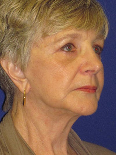 Facelift/Mini-Facelift Before & After Gallery - Patient 4890567 - Image 4