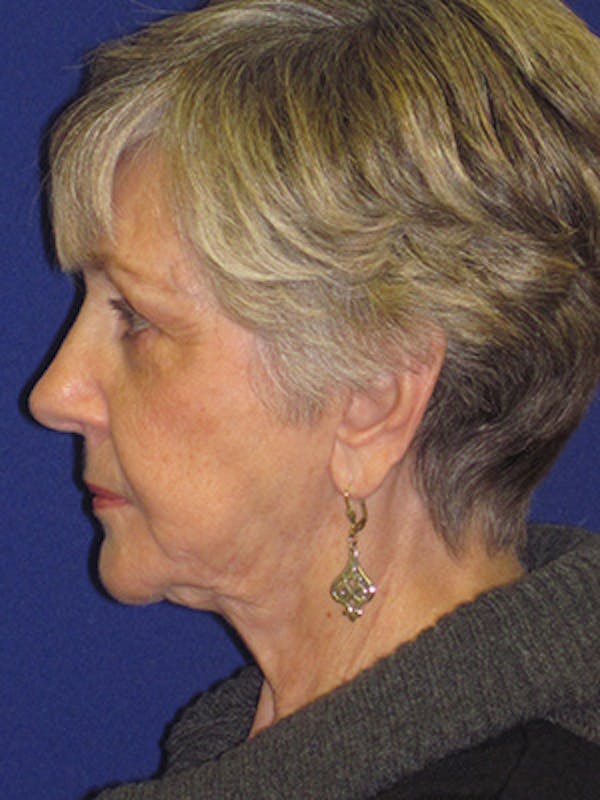 Facelift/Mini-Facelift Before & After Gallery - Patient 4890567 - Image 5
