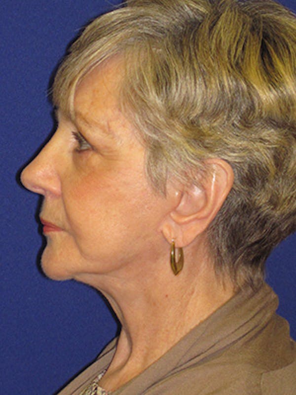 Facelift/Mini-Facelift Before & After Gallery - Patient 4890567 - Image 6