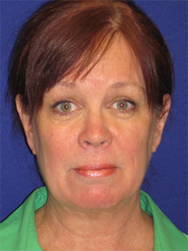 Facelift/Mini-Facelift Before & After Gallery - Patient 4890581 - Image 1