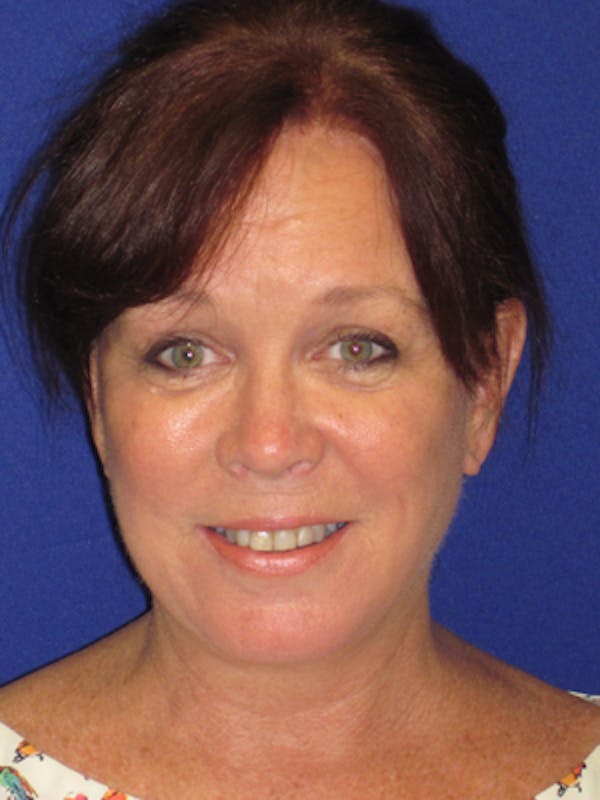 Facelift/Mini-Facelift Before & After Gallery - Patient 4890581 - Image 2