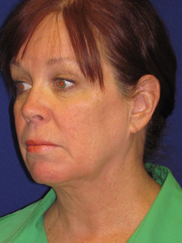 Facelift/Mini-Facelift Before & After Gallery - Patient 4890581 - Image 3