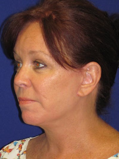 Facelift/Mini-Facelift Before & After Gallery - Patient 4890581 - Image 4