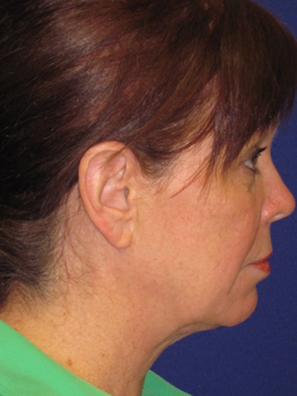 Facelift/Mini-Facelift Before & After Gallery - Patient 4890581 - Image 5