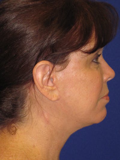 Facelift/Mini-Facelift Before & After Gallery - Patient 4890581 - Image 6