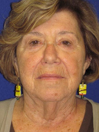 Facelift/Mini-Facelift Before & After Gallery - Patient 4890586 - Image 1