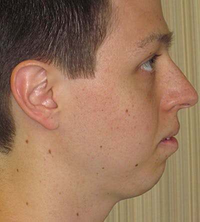 Chin Augmentation Before & After Gallery - Patient 4890583 - Image 1