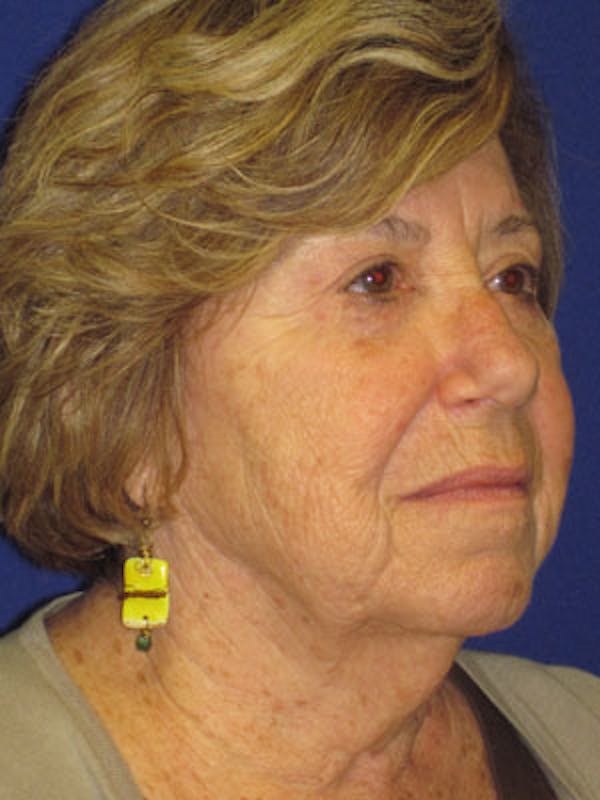 Facelift/Mini-Facelift Before & After Gallery - Patient 4890586 - Image 3