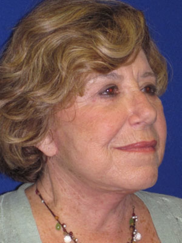 Facelift/Mini-Facelift Before & After Gallery - Patient 4890586 - Image 4