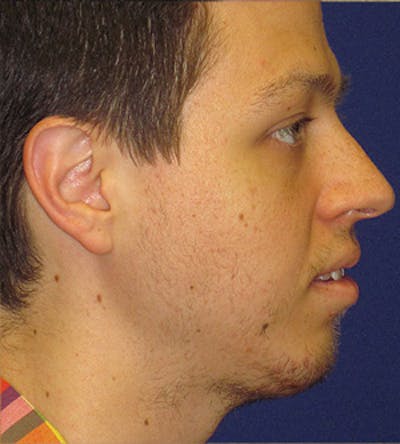 Chin Augmentation Before & After Gallery - Patient 4890583 - Image 2