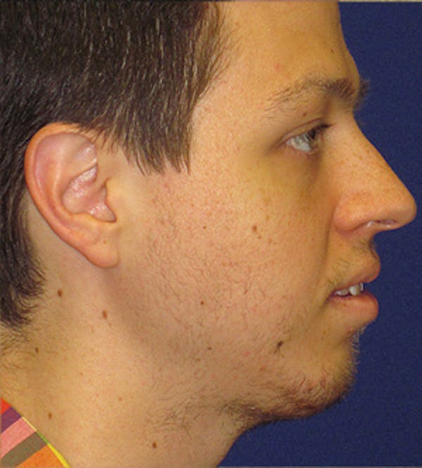 Chin Augmentation Before & After Gallery - Patient 4890583 - Image 2