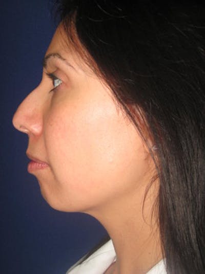Chin Augmentation Before & After Gallery - Patient 4890588 - Image 1