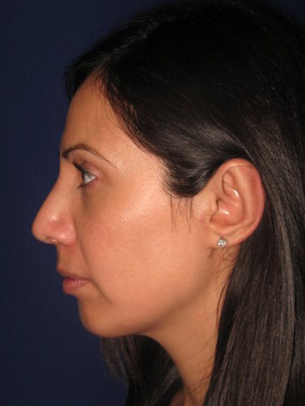 Chin Augmentation Before & After Gallery - Patient 4890588 - Image 2