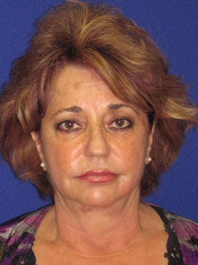 Facelift/Mini-Facelift Before & After Gallery - Patient 4890601 - Image 1
