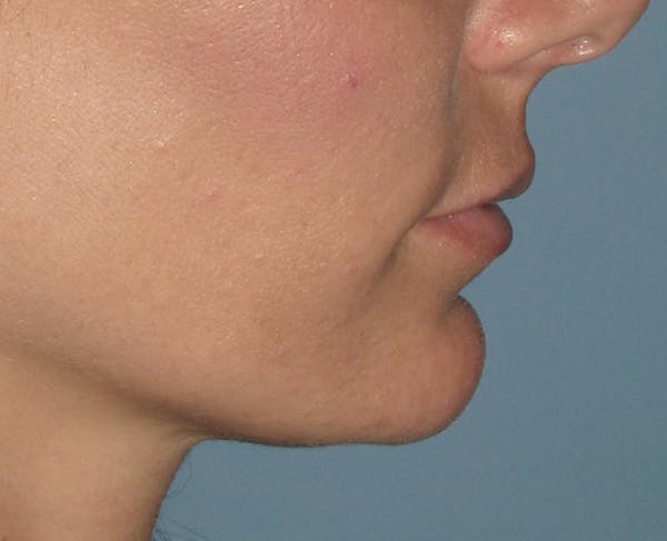 Chin Augmentation Before & After Gallery - Patient 4890590 - Image 1