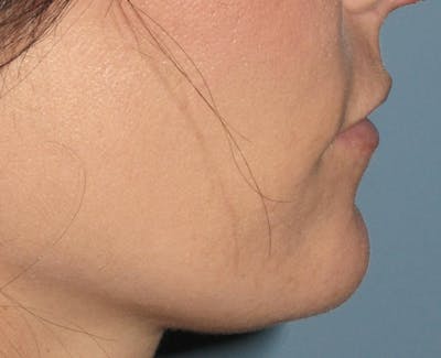 Chin Augmentation Before & After Gallery - Patient 4890590 - Image 2