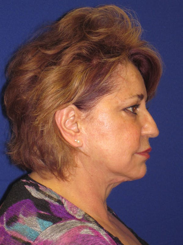 Facelift/Mini-Facelift Before & After Gallery - Patient 4890601 - Image 3