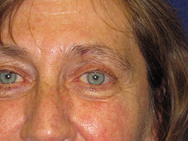Facial Reconstruction Before & After Gallery - Patient 4890599 - Image 2