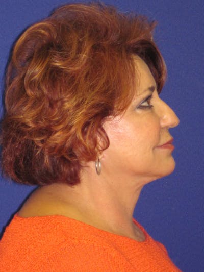 Facelift/Mini-Facelift Before & After Gallery - Patient 4890601 - Image 4
