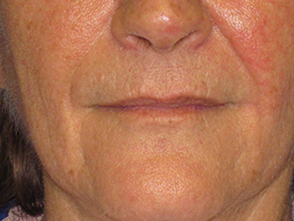 Facial Reconstruction Before & After Gallery - Patient 4890599 - Image 4