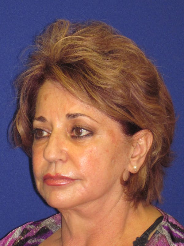 Facelift/Mini-Facelift Before & After Gallery - Patient 4890601 - Image 5