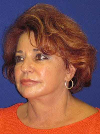 Facelift/Mini-Facelift Before & After Gallery - Patient 4890601 - Image 6