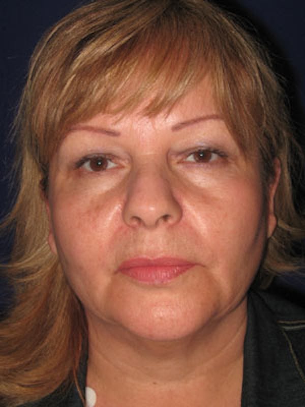 Facelift/Mini-Facelift Before & After Gallery - Patient 4890605 - Image 1