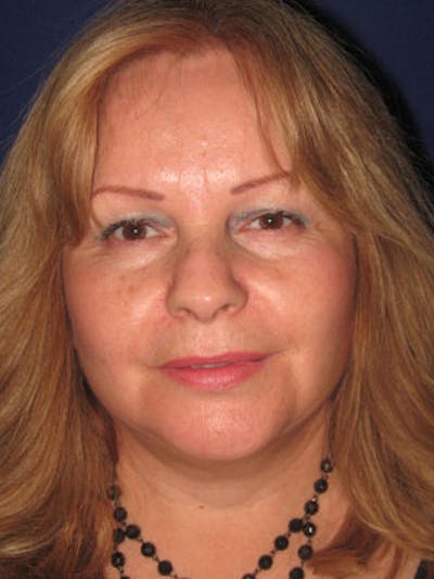 Facelift/Mini-Facelift Before & After Gallery - Patient 4890605 - Image 2