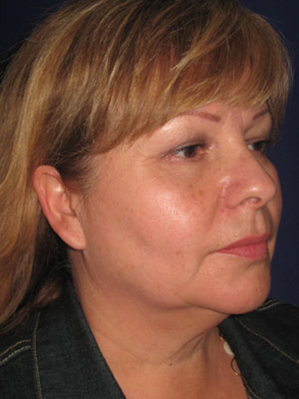 Facelift/Mini-Facelift Before & After Gallery - Patient 4890605 - Image 3