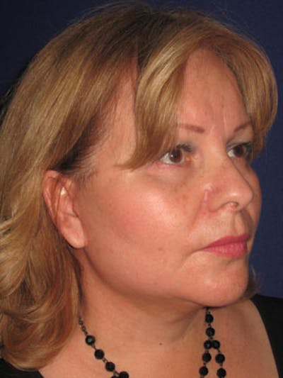 Facelift/Mini-Facelift Before & After Gallery - Patient 4890605 - Image 4