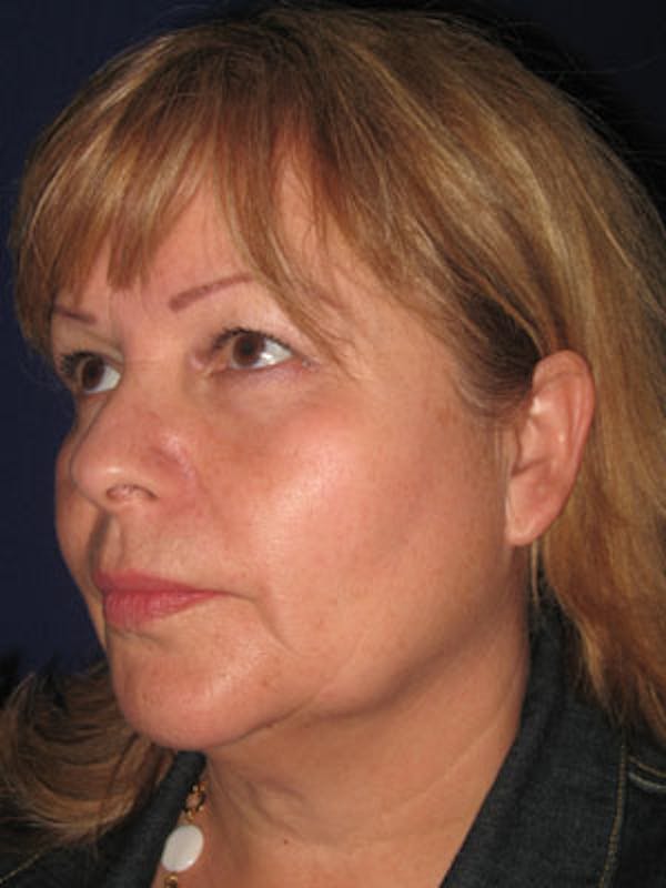 Facelift/Mini-Facelift Before & After Gallery - Patient 4890605 - Image 5