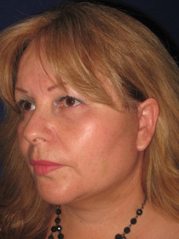 Facelift/Mini-Facelift Before & After Gallery - Patient 4890605 - Image 6
