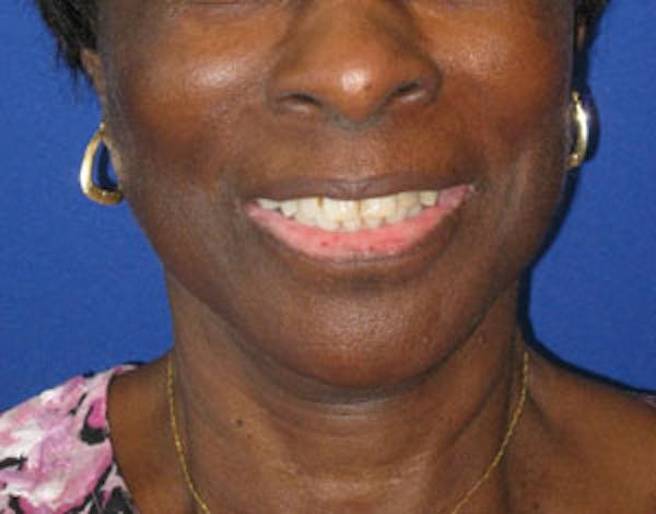 Facelift/Mini-Facelift Before & After Gallery - Patient 4890611 - Image 2