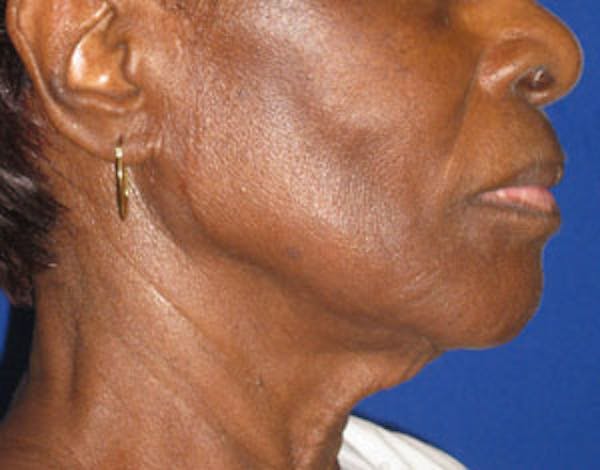 Facelift/Mini-Facelift Before & After Gallery - Patient 4890611 - Image 3