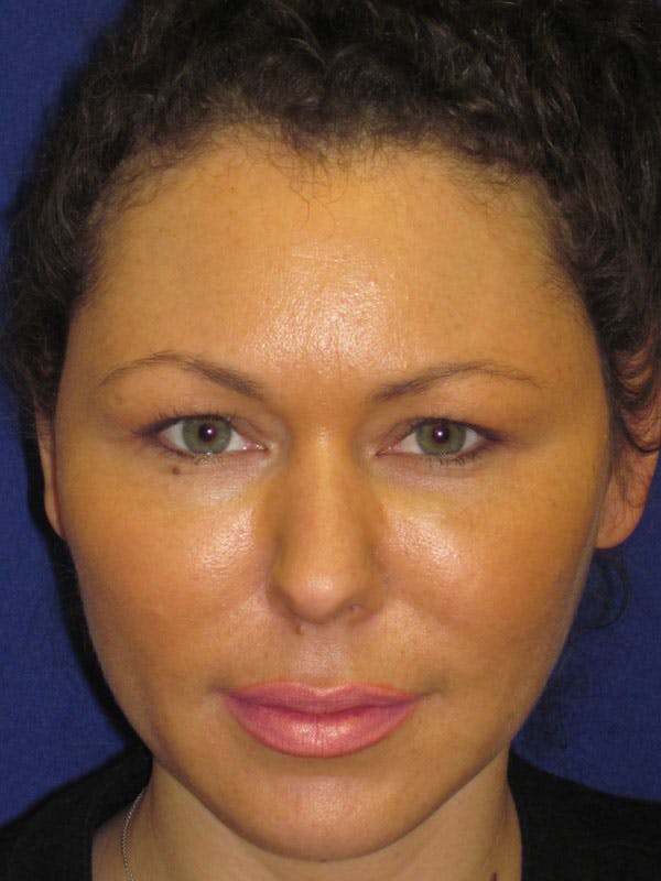 Fat Grafting Before & After Gallery - Patient 4890619 - Image 2
