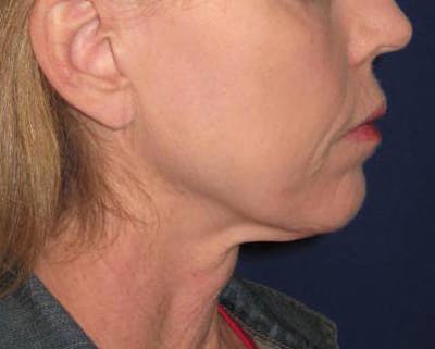 Facelift/Mini-Facelift Before & After Gallery - Patient 4890618 - Image 1