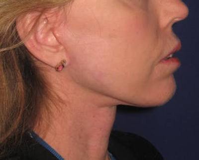 Facelift/Mini-Facelift Before & After Gallery - Patient 4890618 - Image 2