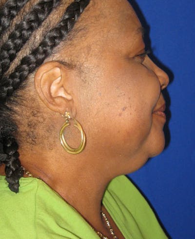 Neck Liposuction Before & After Gallery - Patient 4890620 - Image 1