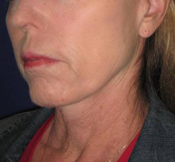 Facelift/Mini-Facelift Before & After Gallery - Patient 4890618 - Image 3