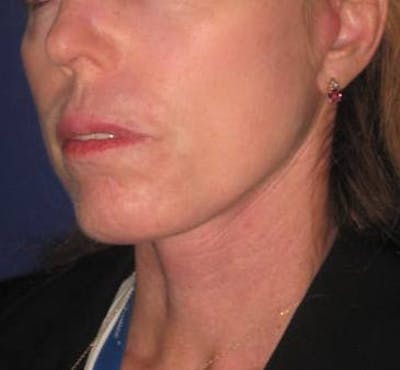 Facelift/Mini-Facelift Before & After Gallery - Patient 4890618 - Image 4