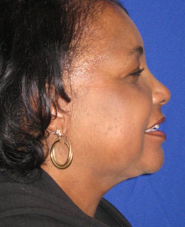 Neck Liposuction Before & After Gallery - Patient 4890620 - Image 2