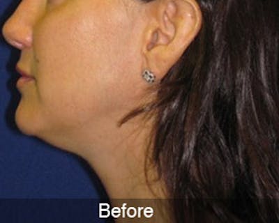 Neck Liposuction Before & After Gallery - Patient 4890622 - Image 1