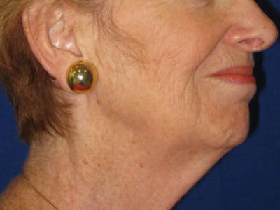 Facelift/Mini-Facelift Before & After Gallery - Patient 4890637 - Image 1