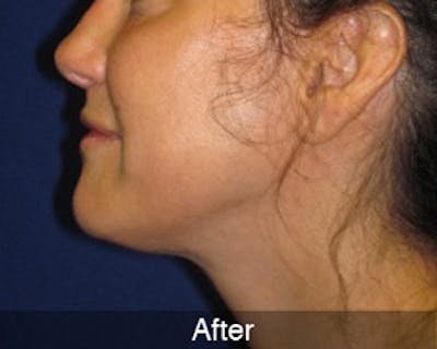 Neck Liposuction Before & After Gallery - Patient 4890622 - Image 2