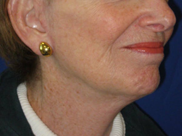 Facelift/Mini-Facelift Before & After Gallery - Patient 4890637 - Image 2