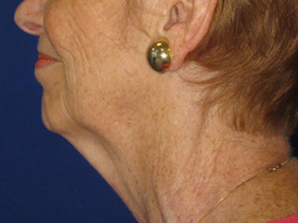Facelift/Mini-Facelift Before & After Gallery - Patient 4890637 - Image 3