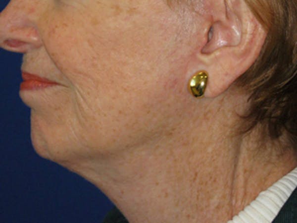 Facelift/Mini-Facelift Before & After Gallery - Patient 4890637 - Image 4