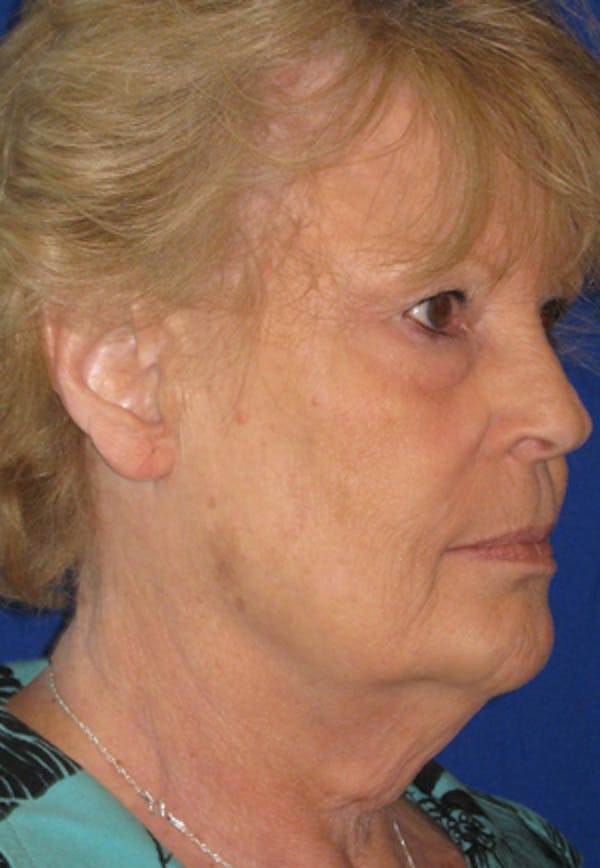 Facelift/Mini-Facelift Before & After Gallery - Patient 4890662 - Image 3